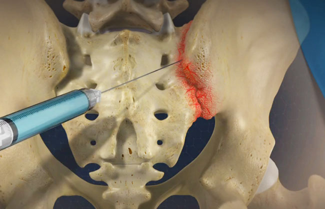 Sacroiliac Joint Injections treatment at ReMeDy Medical Group
