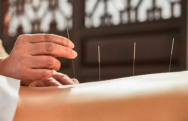 Acupuncture treatment at ReMeDy Medical Group