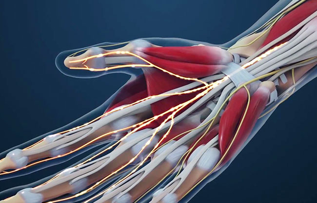 Carpal Tunnel Injections treatment at ReMeDy Medical Group