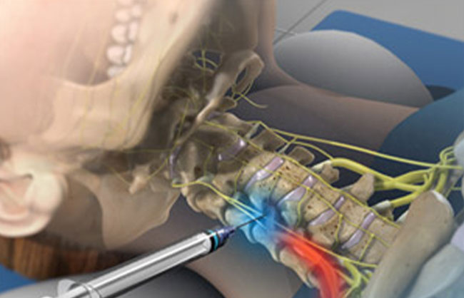 Cervical and Thoracic Epidurals treatment at ReMeDy Medical Group