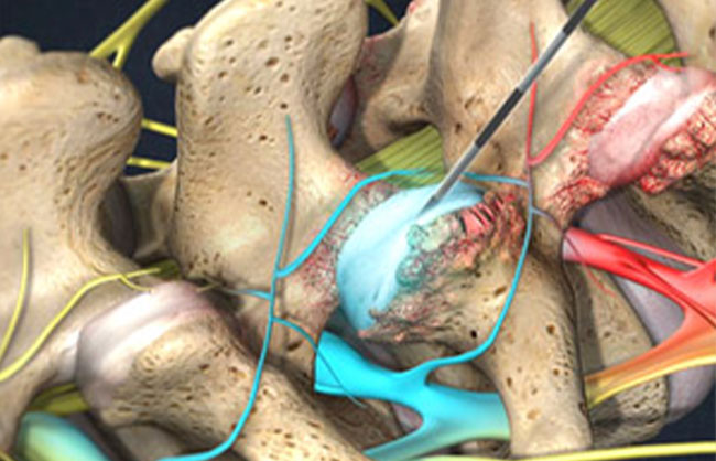 Facet Joint Injections treatment at ReMeDy Medical Group