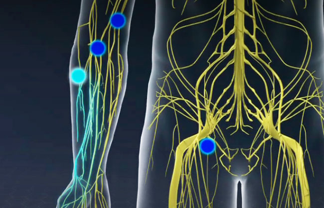 Peripheral Nerve Blocks treatment at ReMeDy Medical Group