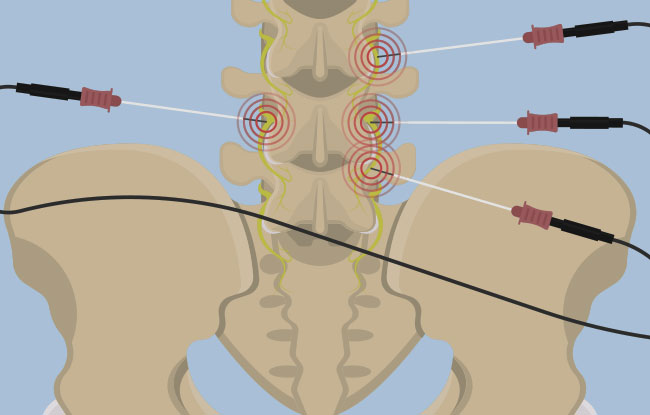 Patient undergoing Pulse Radiofrequency Ablation at ReMeDy Medical Group