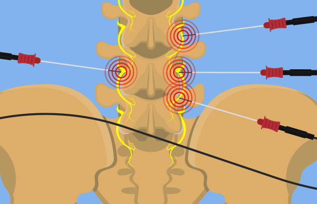 Pulse Radiofrequency Ablation treatment at ReMeDy Medical Group