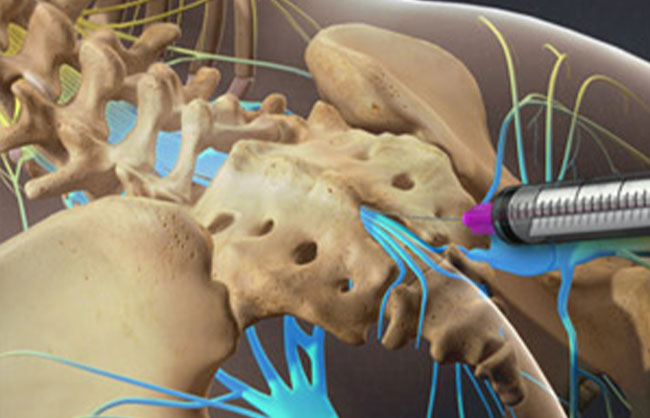 Translaminar Lumbar and Caudal Epidurals treatment at ReMeDy Medical Group